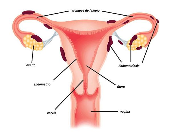 endometriosis ovarica